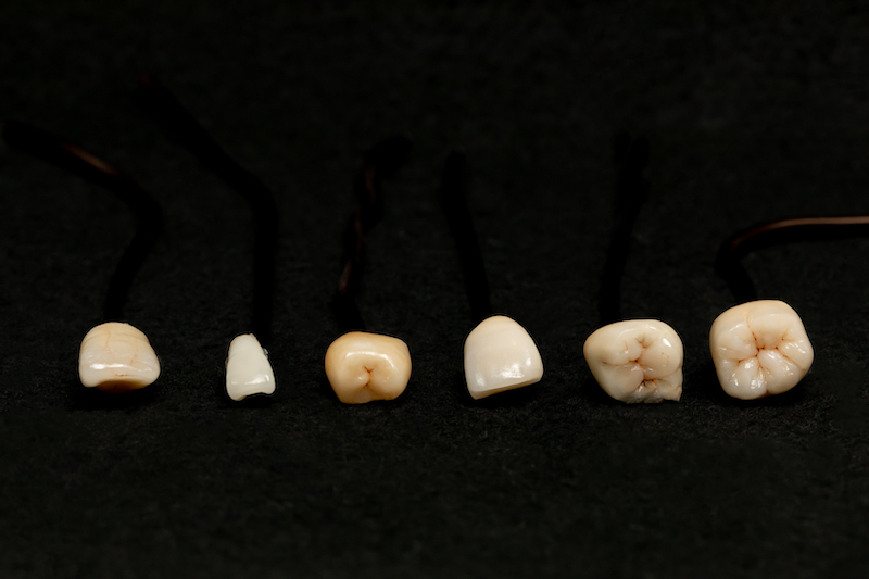 前歯のセラミックと奥歯のセラミックの違い
